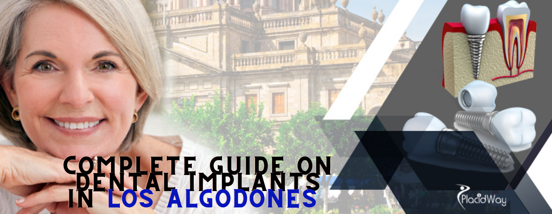 Best 8 Clinics for Dental Implants in Los Algodones, Mexico | Mexico